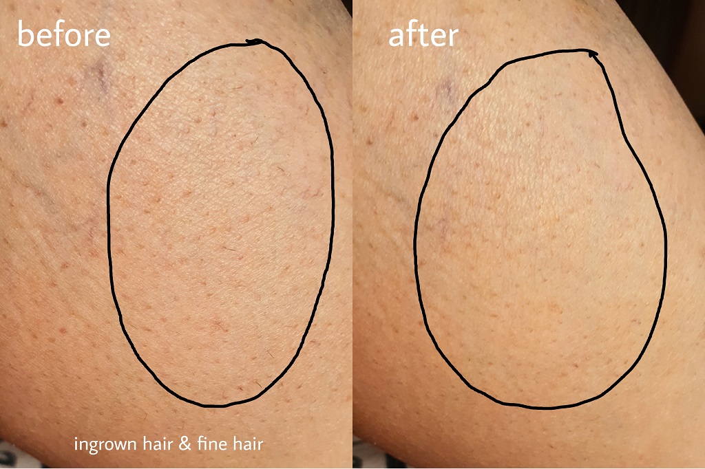 Unik Crystal Hair Remover Before after Sense It Eve UNIK Crystal Hair Remover Review